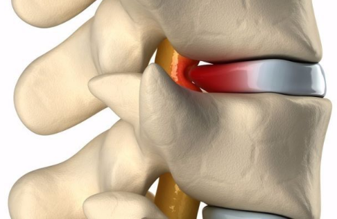腰椎間盤突出這么治，既省心又有效，快搶?。▓D）_3
