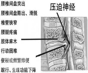 腰椎間盤突出久治不愈？這些問題你都知道嗎？_3