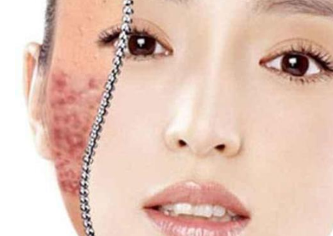 安佩麗絲小知識：去除痘坑的方法告訴你_1