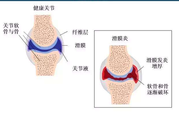 滑膜炎怎么改善好？選對方法很重要（圖）_1