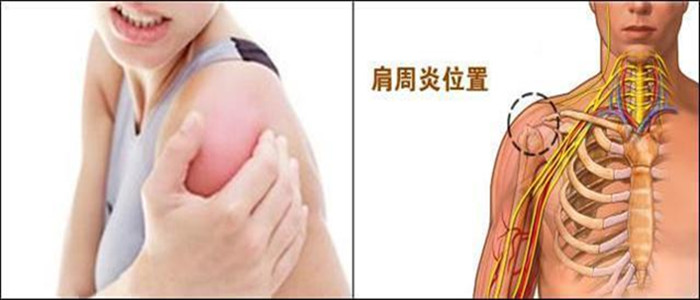 改善肩周炎常见的中医方法你选择了哪个_1