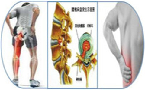 腰椎間盤突出為什么會反復(fù)發(fā)作？看看怎么護理和改善才好?。▓D）_1