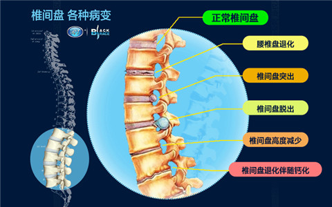 腰椎間盤突出為什么會反復(fù)發(fā)作？看看怎么護理和改善才好?。▓D）_2