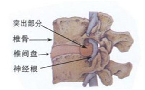 腰椎間盤突出為什么會反復(fù)發(fā)作？看看怎么護理和改善才好！（圖）_3