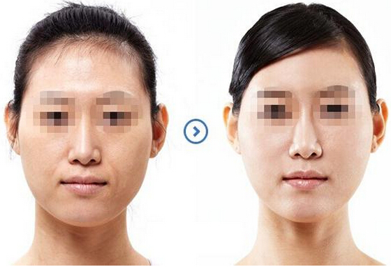 韓國(guó)水光嫩膚儀器哪種好（圖）_1