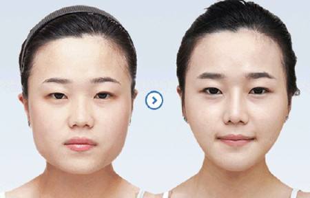 韓國皮膚四合一綜合儀器哪種好（圖）_1