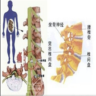 呀！發(fā)現(xiàn)了改善腰間盤突出最好的辦法_2