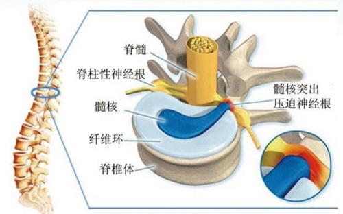 腰椎間盤突出患者，了解腰痛腿痛的毛病嗎_2