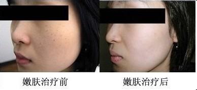 調(diào)q激光祛斑機(jī)價格（圖）_1