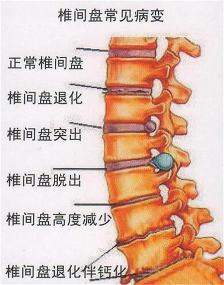 改善腰椎间盘突出一般什么保守改善方法好