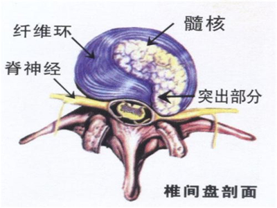 這個方法改善腰椎間盤突出簡單實用關(guān)鍵是效果好（圖）_3
