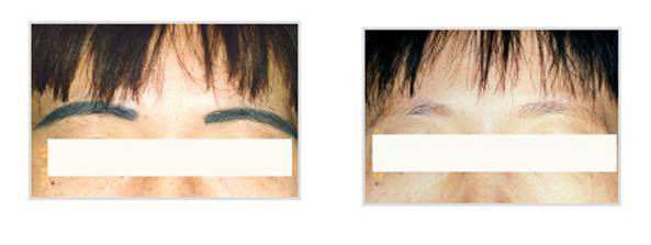 哪個牌子的激光洗眉機好（圖）_1