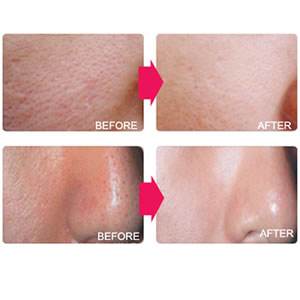 超聲波美容儀哪個牌子好（圖）_1