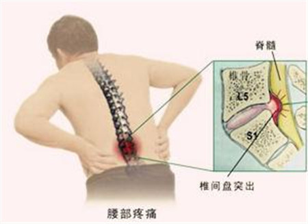 你知道哪些保守改善方法对腰椎间盘突出效果好？_1