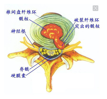 你知道哪些保守改善方法对腰椎间盘突出效果好？_2
