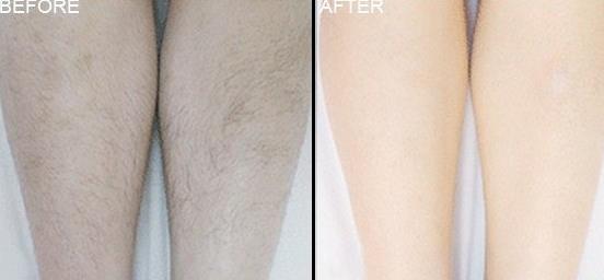 美容院激光脫毛儀器多少錢一臺（圖）_1