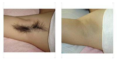 美容院激光脫毛儀器多少錢一臺（圖）_2