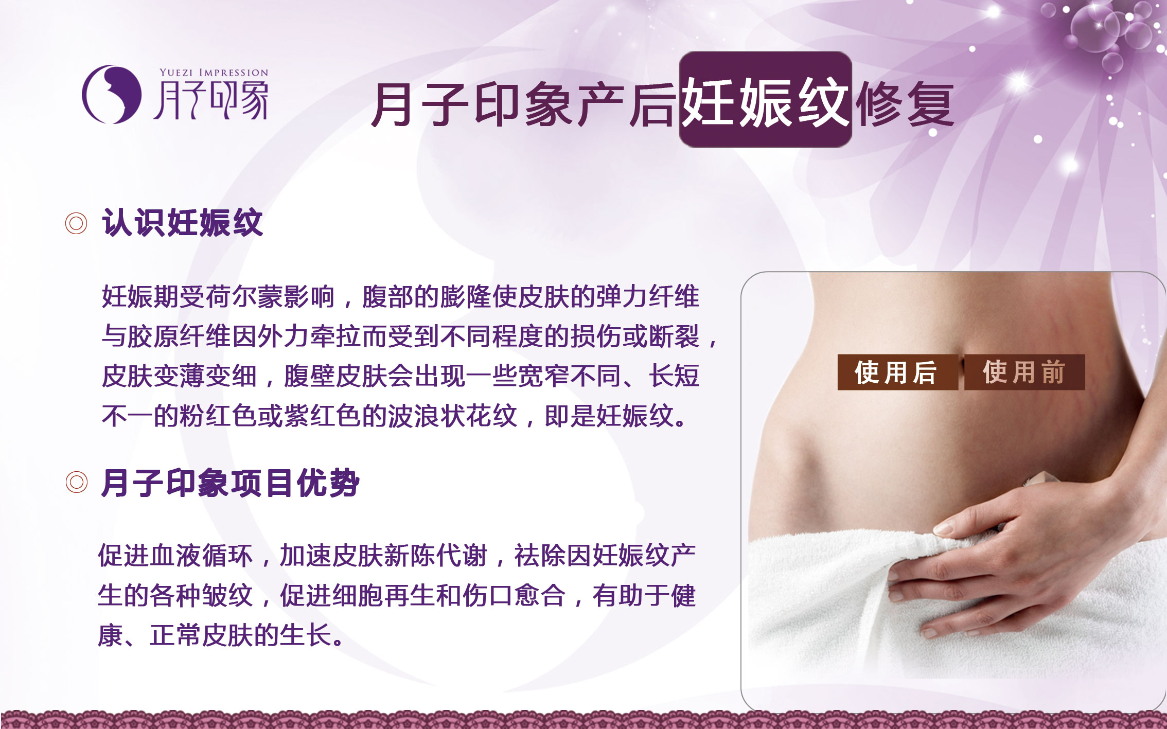 【產(chǎn)后修復】月子印象產(chǎn)后妊娠紋修復秘訣，輕松做辣媽_1