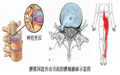 孩子太胖也會導(dǎo)致腰椎間盤突出？快看看怎么改善？（圖）_2