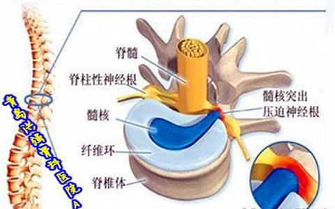 改善腰椎間盤(pán)突出，用什么方法最有效？最省錢？（圖）_2