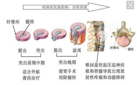 幫你徹底消滅腰椎間盤突出的好方法，趕緊看看！_1