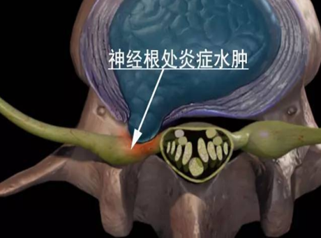 腰椎間盤突出疼痛難忍，別急，一個方法治好腰突_1