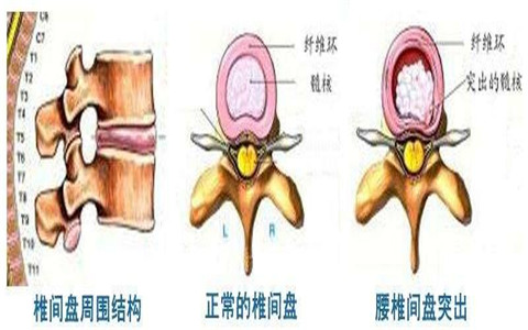 腰椎间盘突出改善要合理正确，不要盲目！（图）_1