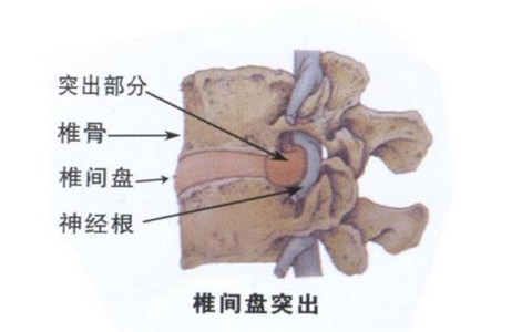 腰椎间盘突出改善要合理正确，不要盲目！（图）_3