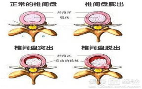 腰椎间盘突出治疗要做到十不两护轻松治愈图