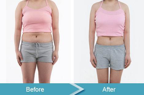 爆脂減肥瘦身儀哪款效果好？（圖）_1