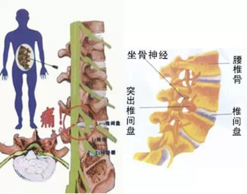 腰間盤(pán)突出選擇什么方法改善正確有效_1