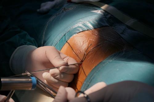 改善腰椎間盤突出難嗎？看看這些步驟_2