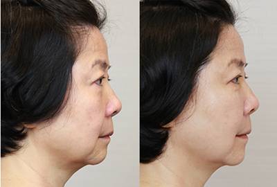 提拉緊致儀器多少錢一臺(tái)提拉緊致儀器價(jià)格(圖)_2