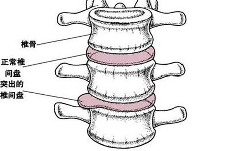 王九正改善腰椎間盤突出效果好的不得了?。▓D）_2