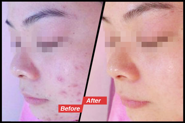 全國祛痘加盟品牌哪家好？_2