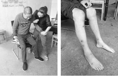 滑膜炎是怎么引起的以及最佳改善方法（圖）_1