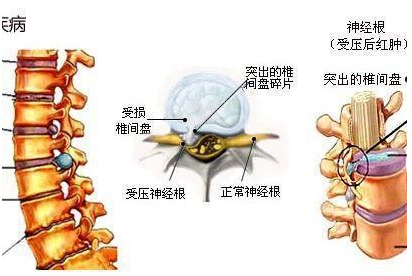 腰疼最快的方法怎么治腰疼怎么缓解？（图）_1