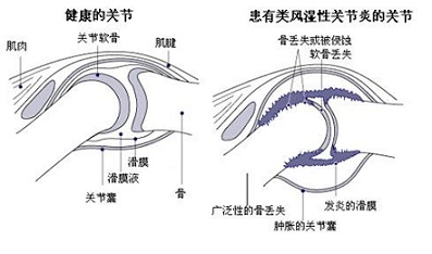 想要治好類風(fēng)濕性關(guān)節(jié)炎你就得做的這么全面_1