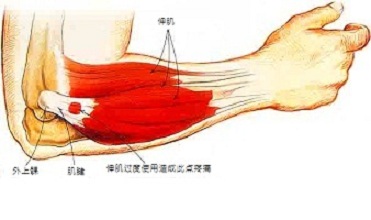 想要治好网球肘做好这些就够了_1