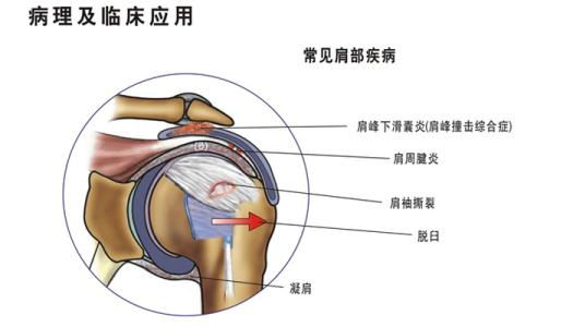 改善肩周炎的方法幾個療程輕松治好了_1