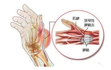 带你全面认识腱鞘炎及其改善方法_1