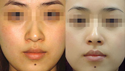 清潔美容儀多少錢一臺（圖）_4