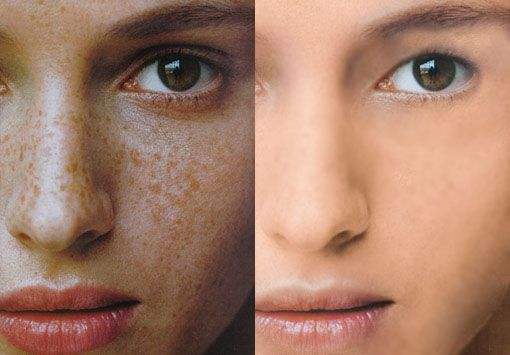 激光祛斑儀器有哪些（圖）_2