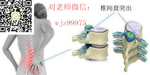 有人用馬明仁膏藥改善腰椎間盤突出改善好的嗎_2