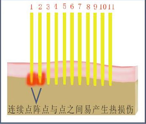 1550点阵激光祛疤仪器价格（图）_1