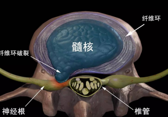 仙草活骨膏是实践出来的真效果改善腰疼真好（图）_1