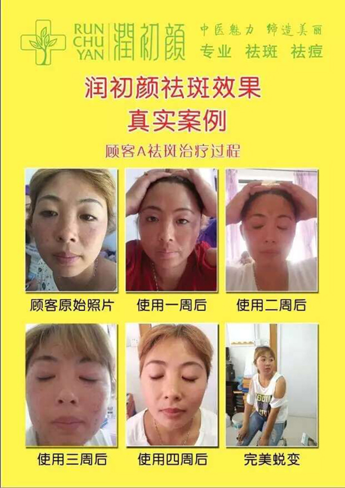 開家品牌祛斑加盟店怎么樣？_2