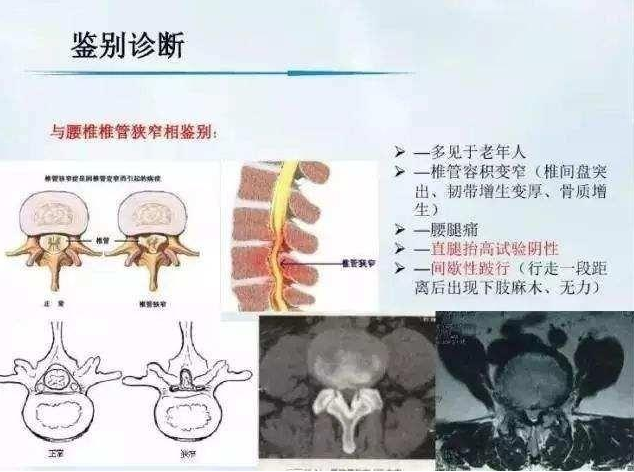 腰间盘突出哪里能够看好能够贴膏药中药方法改善吗？（图）_1