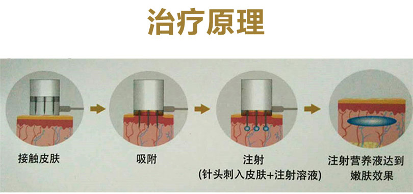 水光注射Aquasunny阿斯汀儀器價格（圖）_2