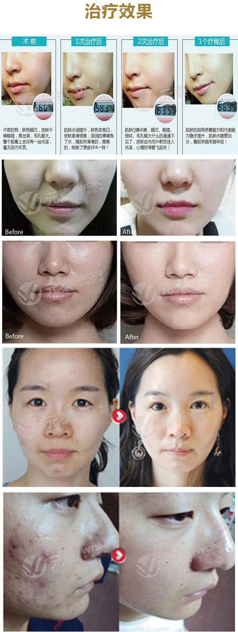 水光注射Aquasunny阿斯汀儀器價格（圖）_5